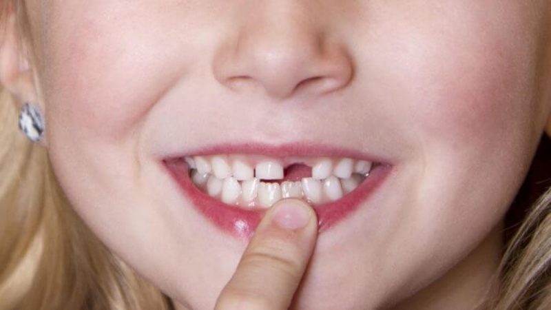 &Yacute; nghĩa đặc biệt của giấc chi&ecirc;m bao thấy rụng răng
